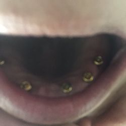 Comfort Dental - On the left of this picture (it's actually my right side) you can see the spot where the 6th screw is supposed to go.