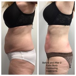 Renuvity Med Spa - BTL Exilis Ultra Skin tightening and Body Contouring