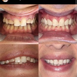 My teeth before and after!! My teeth before and after!!