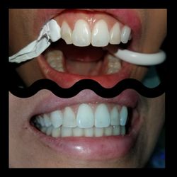 Maspeth USmiles Dental Care - Chipped tooth from a silly accident