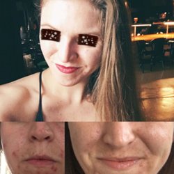 Esperanza Esthetics - Before & After Custom Active Acne & Scar Resolution Series!