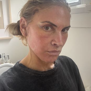 Davis Facial Plastics - Day 6 Post Op - Plastic Surgeons Near Me - Beverly Hills, California