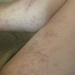 Laser hair removal