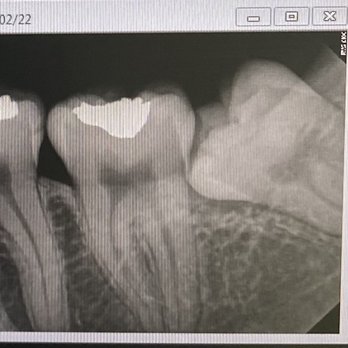New Age Dental Clinic - The impacted tooth - Oral Surgeons Near Me - Tijuana, BCN