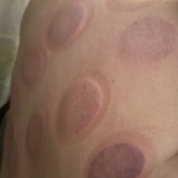 Yunduo Massage Spa - Right after 90min pain relief + cupping session - Medical Spas Near Me - West Covina, California