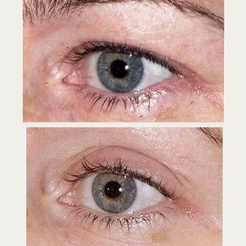 Oya Aesthetics Center - Thermage eyelid tightening treatment - Medical Spas Near Me - Rowland Heights, California Oya Aesthetics Center - Thermage eyelid tightening treatment - Medical Spas Near Me - Rowland Heights, California