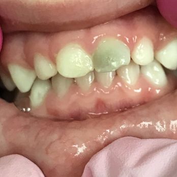 Yu Jocelyn E, DDS - Discolored tooth from an injury - Pediatric Dentists Near Me - The Colony, Texas Yu Jocelyn E, DDS - Discolored tooth from an injury - Pediatric Dentists Near Me - The Colony, Texas
