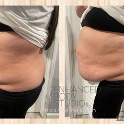 Enhanced Body Studio - After one session of wood therapy