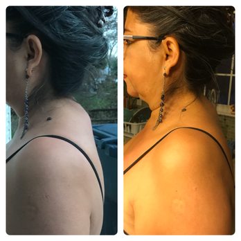 Johnny Veira - Kyphosis, shoulder, and neck pain decreased after 1hr session - Trainers Near Me Johnny Veira - Kyphosis, shoulder, and neck pain decreased after 1hr session - Trainers Near Me