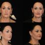 Mark A Anton, MD - FACS Aesthetics