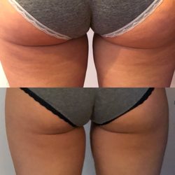 Red Carpet On Queen - These is before and after lipomassage to remove cellulite and Perky the buttocks