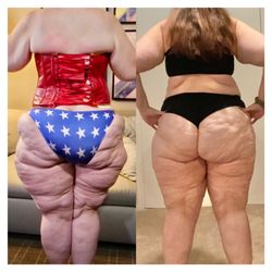 Liza Kim, MD - Stage 3/4 lipedema type 2&4. Post op 2 Lipedema debulking by liposuction