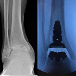 Martina Randall, DPM - Total Ankle Replacement performed by Dr. Randall