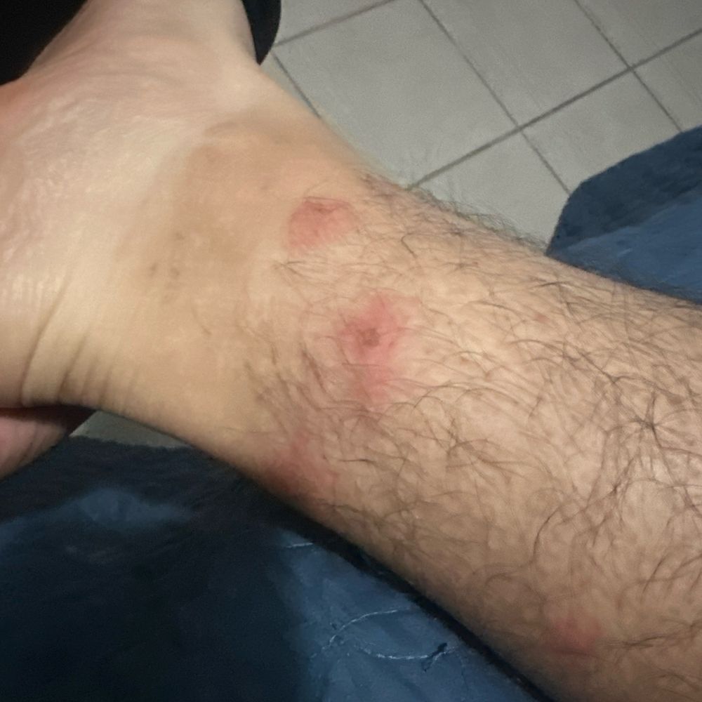 Super 8 by Wyndham - Goshen - Bed bug bite - Hotels Near Me - Goshen, Indiana Super 8 by Wyndham - Goshen - Bed bug bite - Hotels Near Me - Goshen, Indiana