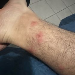 Super 8 by Wyndham - Goshen - Bed bug bite