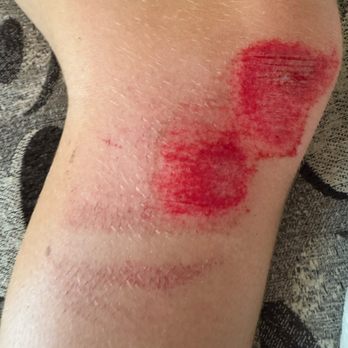 St Timothy Urgent Care - dirt bike crash road rash - Urgent Care Near Me - Odessa, Florida St Timothy Urgent Care - dirt bike crash road rash - Urgent Care Near Me - Odessa, Florida