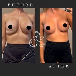 Charles A  Messa , III, MD,FACS - Before and 10 days post op breast lift with augmentation (Motiva mini 310cc)