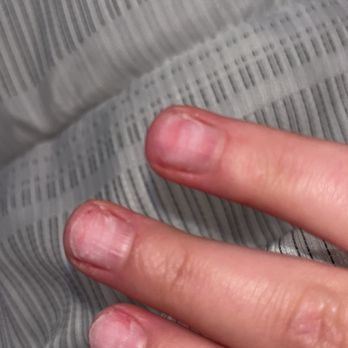 Lynn's Nails - Damage done to nails after removal - Nail Salons Near Me - Columbus, Indiana