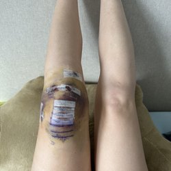 LoHi Lipo Laser Clinic - ACL surgery, muscle still intact 1 week post op.