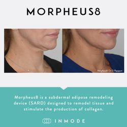 Michael Kerin, MD - Kerin MedSpa & Laser Center - Morpheus8 or Morpheus is a subdermal skin remodeling RF Microneedling device that stimulates the production of collagen.