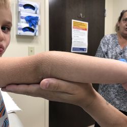Atmed Treatment Center - My pumpkins elbow :(