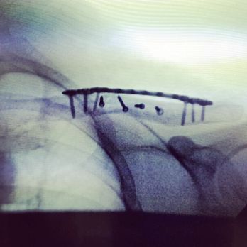 Killington Resort - Plate and 10 screws in my husband's left clavicle (in addition to three broken ribs) ... proof for the ignorant bike rental employee. - Ski Resorts Near Me - Killington, Vermont