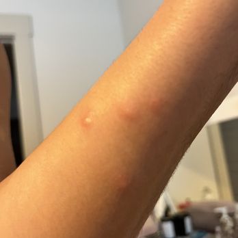 Rancho Magdalena - Bed bug bites - Vacation Rentals Near Me - Valley Center, California Rancho Magdalena - Bed bug bites - Vacation Rentals Near Me - Valley Center, California