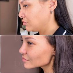 Holistic Health and Laser Hair Removal Clinic - Mesotherapy
