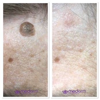 Mederm Esthetics & Laser - Electrocautery - Laser Hair Removal Near Me - Concord, Ontario Mederm Esthetics & Laser - Electrocautery - Laser Hair Removal Near Me - Concord, Ontario