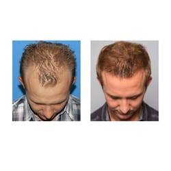 Bosley Hair Restoration & Transplant