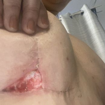 Saldaña Angulo Julio Dr - It has taken 2 months to heal. - Cosmetic Surgeons Near Me - Tijuana, BCN Saldaña Angulo Julio Dr - It has taken 2 months to heal. - Cosmetic Surgeons Near Me - Tijuana, BCN