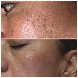 Contour Body Aesthetics - Removing skin tags , moles and dark spots with the Lamprobe treatment.
