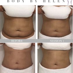 Body Contouring - INSTAGRAM PAGE body_by_helen
Weight Loss