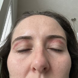 Eye lids burnt Eye lids burnt