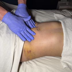 AcuSpa Wellness Center - Post surgery lymphatic drainage massage
