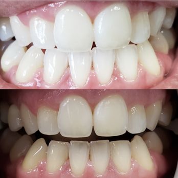 Ultra Brite Smiles - Bottom: before whitening treatment. Top: after whitening treatment. - Teeth Whitening Near Me - Redlands, California Ultra Brite Smiles - Bottom: before whitening treatment. Top: after whitening treatment. - Teeth Whitening Near Me - Redlands, California