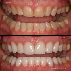 Harmony Dentistry - 18 Natural porcelain veneers placed for function and aesthetics done by Dr. Ash :)
