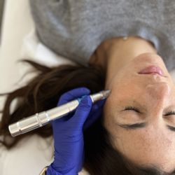 Espiritu Acupuncture and Wellness - Microneedling