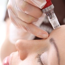 Fresh Faces - Micro-Needling/ CIT-Collagen Induction Therapy. Promotes the skin's natural ability to create collagen and to help reveal a healthy skin.