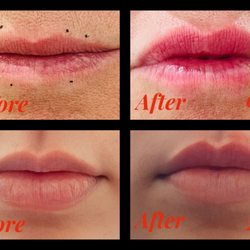 Graceful Lines Aesthetics - Lip Flips