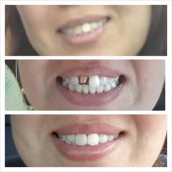 Roca Dental - Before, filing my tooth b4 temporary and original crown! You cannot notice much in the before picture but it was really dark.