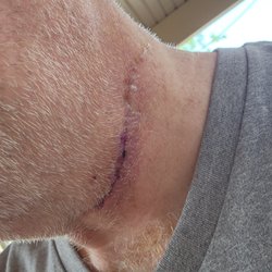 Shafi Khalid, MD - My scar healing well from a real Doctor lol