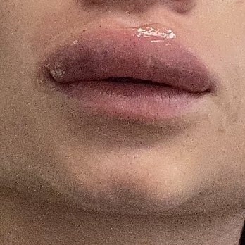 Kiva Medspa IV Lounge - Dissolving process... this was traumatic!! After they got back to normal, my lips and my skin remain bruised - Medical Spas Near Me - Orlando, Florida Kiva Medspa IV Lounge - Dissolving process... this was traumatic!! After they got back to normal, my lips and my skin remain bruised - Medical Spas Near Me - Orlando, Florida