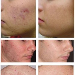 Innovative Aesthetics - Acne facials / peels
