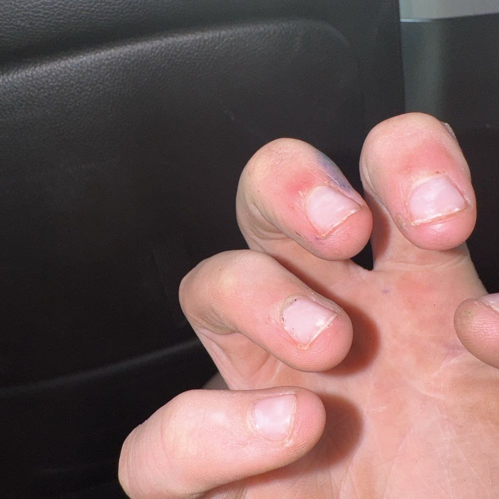 Clear gel that has been on for a month