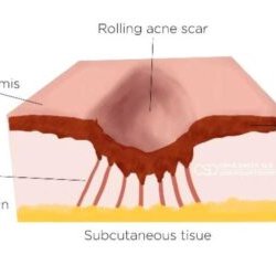 Craig Singer, MD - Subcision for acne scarring