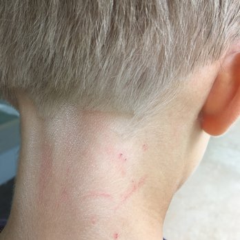 Snipedy DO Dahs Kid Salon - Skin damage after haircut. The skin already disinfected by antiseptic napkins. - Hair Salons Near Me - Boca Raton, Florida Snipedy DO Dahs Kid Salon - Skin damage after haircut. The skin already disinfected by antiseptic napkins. - Hair Salons Near Me - Boca Raton, Florida