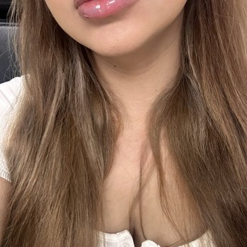 NakedMD - Immediately after - Medical Spas Near Me - Downey, California NakedMD - Immediately after - Medical Spas Near Me - Downey, California