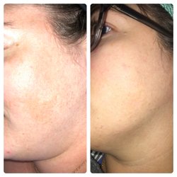 Esthetics By Skylar - Results from 6 Lactic Acid chemical peels and two dermaplaning treatments for the sun damage spot on her cheek!