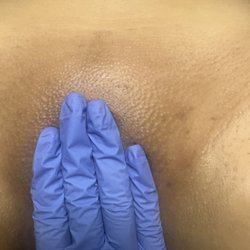 Elle Noir Aesthetics - After photo or a Brazilian Wax